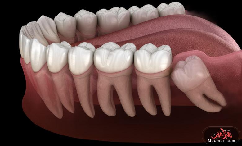 علاج تسوس الأسنان