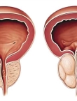 علاج تضخم البروستاتا