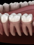 علاج تسوس الأسنان