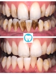 تبييض الأسنان الغامقة أو البني