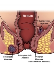 الناسور الشرجي المستقيمي